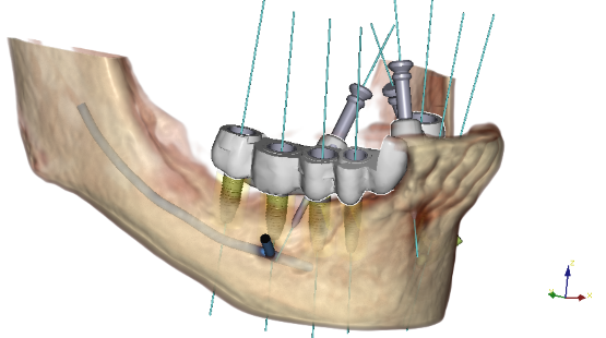 Fully Guided Implant Placement Folder Johor Bahru (JB) | Dental Clinic Johor Bahru (JB) | Children Friendly Dentist Johor Bahru (JB) | Invisalign Johor Bahru (JB)